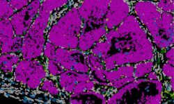 Ciertas células del tumor de cáncer de mama adoptan un estado de capacidad de metástasis coordinadas por el gen Prrx1. Imagen: Instituto de Neurociencias (CSIC-UMH).