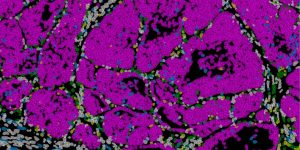 Ciertas células del tumor de cáncer de mama adoptan un estado de capacidad de metástasis coordinadas por el gen Prrx1. Imagen: Instituto de Neurociencias (CSIC-UMH).