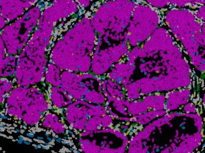 Ciertas células del tumor de cáncer de mama adoptan un estado de capacidad de metástasis coordinadas por el gen Prrx1. Imagen: Instituto de Neurociencias (CSIC-UMH).