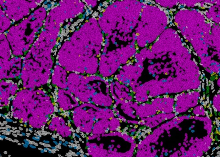 Ciertas células del tumor de cáncer de mama adoptan un estado de capacidad de metástasis coordinadas por el gen Prrx1. Imagen: Instituto de Neurociencias (CSIC-UMH).