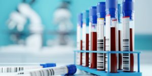 Un análisis de sangre permite detectar de forma temprana el Párkinson.