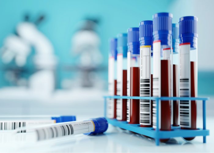 Un análisis de sangre permite detectar de forma temprana el Párkinson.