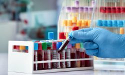 Un biomarcador en sangre podría detectar la enfermedad de alzheimer en sus etapas iniciales