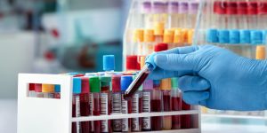 Un biomarcador en sangre podría detectar la enfermedad de alzheimer en sus etapas iniciales