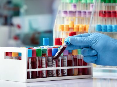 Un biomarcador en sangre podría detectar la enfermedad de alzheimer en sus etapas iniciales