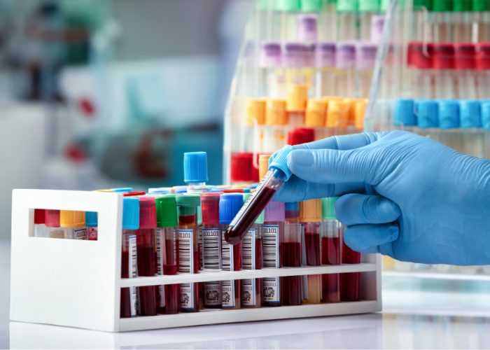 Un biomarcador en sangre podría detectar la enfermedad de alzheimer en sus etapas iniciales