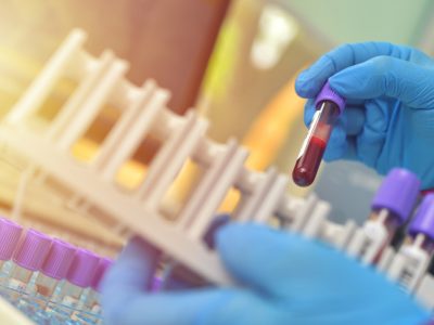 Un estudio plantea que se podría detectar la enfermedad de Lafora en un análisis simple de sangre