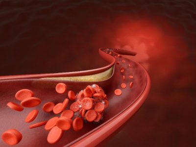 Un reciente artículo resume los tipos de predisposición genética a la enfermedad coronaria y su impacto en prevención, diagnóstico y tratamiento.