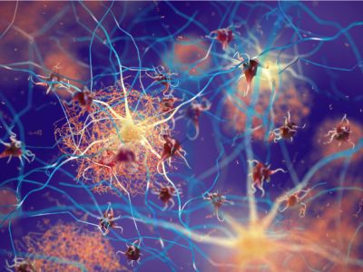 Una nueva estrategia terapéutica ha evaluado el potencial de las células CAR-T para atacar las placas de proteína beta amiloide en tejido nervioso que comprometen en funcionamiento de las neuronas y que caracterizan la enfermedad de Alzheimer