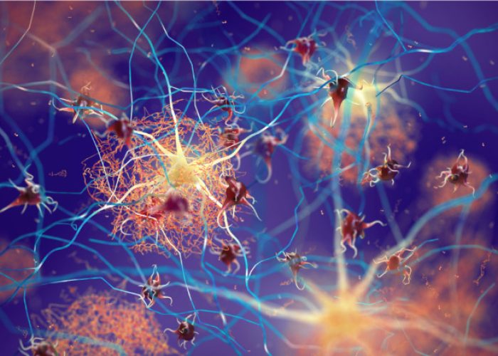 Una nueva estrategia terapéutica ha evaluado el potencial de las células CAR-T para atacar las placas de proteína beta amiloide en tejido nervioso que comprometen en funcionamiento de las neuronas y que caracterizan la enfermedad de Alzheimer