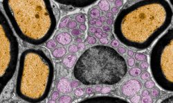 Una terapia génica mejora síntomas de adrenoleucodistrofia, enfermedad metabólica que afecta a la formación de mielina. La imagen muestra una captura de microscopio electrónico de tejido nervioso, donde la mielina que recubre terminaciones nerviosas se muestra en negro