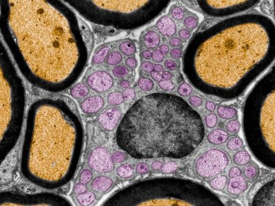 Una terapia génica mejora síntomas de adrenoleucodistrofia, enfermedad metabólica que afecta a la formación de mielina. La imagen muestra una captura de microscopio electrónico de tejido nervioso, donde la mielina que recubre terminaciones nerviosas se muestra en negro