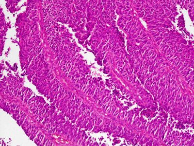 Carcinoma urotelial. Imagen: National Institute of Cancer, National Institute of Health, NIH).