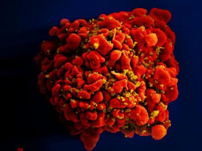 Linfocito infectado con partículas de VIH. Imagen: National Institute of Allergy and Infectious Diseases.