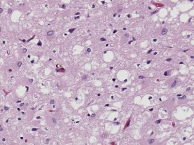 Tejido cerebral afectado por la enfermedad priónica de Creutzfeldt Jakob. Imagen: Photo Credit: Sherif Zaki; MD; PhD; Wun-Ju Shieh; MD; PhD; MPH.