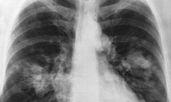 Radiografía de un cáncer de pulmon.