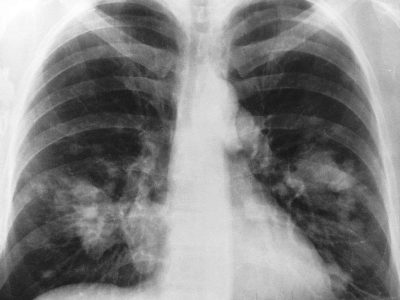 Radiografía de un cáncer de pulmon.