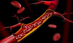 La aterosclerosis es una enfermedad crónica caracterizada por la acumulación de colesterol y otras sustancias en las arterias.