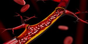 La aterosclerosis es una enfermedad crónica caracterizada por la acumulación de colesterol y otras sustancias en las arterias.