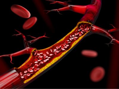 La aterosclerosis es una enfermedad crónica caracterizada por la acumulación de colesterol y otras sustancias en las arterias.