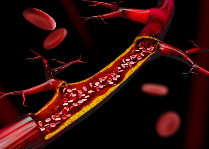 La aterosclerosis es una enfermedad crónica caracterizada por la acumulación de colesterol y otras sustancias en las arterias.