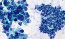 Adenocarcinoma de páncreas a la izquierda, en comparación con epitelio normal a la derecha. Imagen: Ed Uthman (http://creativecommons.org/licenses/by/2.0).