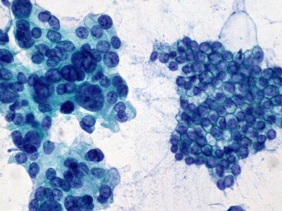 Adenocarcinoma de páncreas a la izquierda, en comparación con epitelio normal a la derecha. Imagen: Ed Uthman (http://creativecommons.org/licenses/by/2.0).