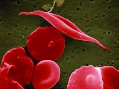 anemia-falciforme-NCATS-NIH.jpg