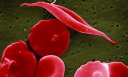 Los pacientes con anemia falciforme producen eritrocitos con forma anómala. En la imagen, eritrocitos normales con forma de disco y eritrocitos falciformes, de forma alargada. Imagen: National Center for Advancing Translational Sciences (NCATS), National Institutes of Health.