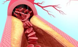 Una mutación en el gen ACTA2 deriva en la formación de placas ateroscleróticas en la aorta, independientemente de los niveles de colesterol y otras grasas. Un reciente estudio revela por qué. Imagen: Science Photo Library, via Canva.