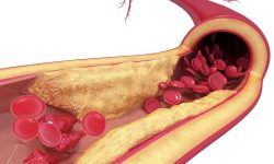 La aterosclerosis se caracteriza por la acumulación anormal de lípidos y células sanguíneas en las paredes arteriales, lo que lleva a un estrechamiento progresivo de los vasos sanguíneos. Imagen: Science Photo Library, vía canva.