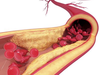 La aterosclerosis se caracteriza por la acumulación anormal de lípidos y células sanguíneas en las paredes arteriales, lo que lleva a un estrechamiento progresivo de los vasos sanguíneos. Imagen: Science Photo Library, vía canva.
