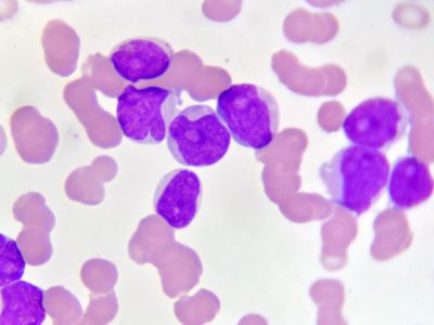 La secuenciación del genoma completo en cáncer pediátrico puede ayudar a precisar diagnóstico o tratamiento. En la imagen, células de leucemia. Imagen: Getty Images, vía Canva.