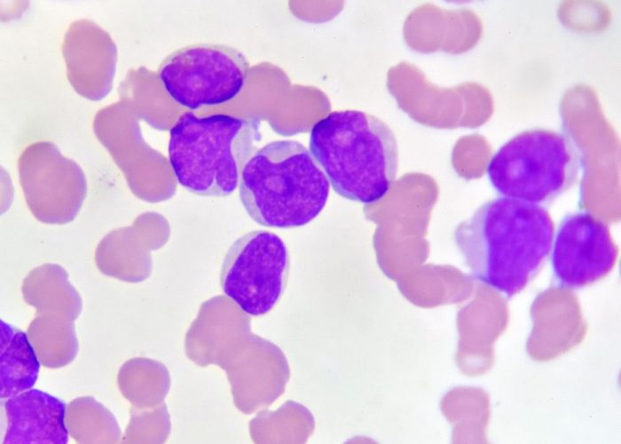 La secuenciación del genoma completo en cáncer pediátrico puede ayudar a precisar diagnóstico o tratamiento. En la imagen, células de leucemia. Imagen: Getty Images, vía Canva.