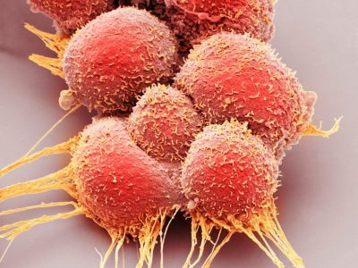 Células de cáncer de próstata en una imagen de microscopía electrónica coloreada. Imagen: Science Photo Library vía Canva.