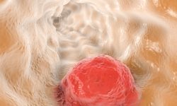 La aparición de mutaciones en proteínas implicadas en el procesado del ARN mensajero es frecuente en las células del cáncer. Ahora, un estudio aprovecha esta característica para atacar las células tumorales de forma específica. Imagen: Getty Images.