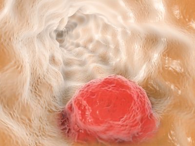 La aparición de mutaciones en proteínas implicadas en el procesado del ARN mensajero es frecuente en las células del cáncer. Ahora, un estudio aprovecha esta característica para atacar las células tumorales de forma específica. Imagen: Getty Images.
