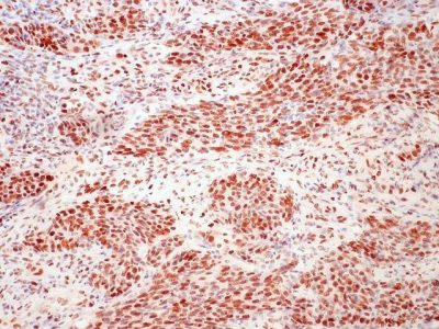Carcinoma renal, tinción con hierro. Imagen: cnicholsonpath (CC BY 2.0 http://creativecommons.org/licenses/by/2.0)