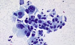 Las biopsias líquidas se basan en la detección en plasma del ADN tumoral liberado por las células del cáncer cuando mueren o la detección de células tumorales circulantes en sangre. En la imagen: Células de cáncer de pulmón no microcítico, Ed Uthman (CC BY 2.0 https://creativecommons.org/licenses/by/2.0/).
