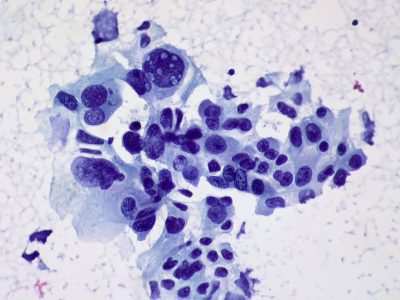 Las biopsias líquidas se basan en la detección en plasma del ADN tumoral liberado por las células del cáncer cuando mueren o la detección de células tumorales circulantes en sangre. En la imagen: Células de cáncer de pulmón no microcítico, Ed Uthman (CC BY 2.0 https://creativecommons.org/licenses/by/2.0/).