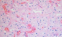 Carcinoma de células renales. Imagen: cnicholsonpath (https://creativecommons.org/licenses/by/2.0/).