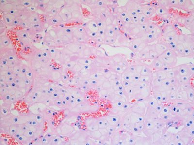 Carcinoma de células renales. Imagen: cnicholsonpath (https://creativecommons.org/licenses/by/2.0/).