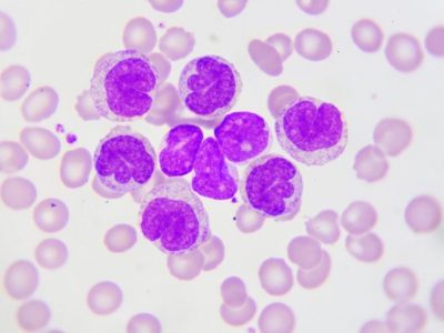 Células de leucemia. Imagen: Getty Images vía Canva.