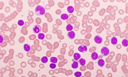 La nueva terapia para la leucemia linfoblástica de células T se basa en células CAR-T diseñadas para atacar células T tumorales y dejar intactas las células T normales