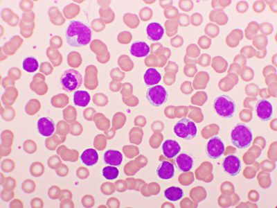 La nueva terapia para la leucemia linfoblástica de células T se basa en células CAR-T diseñadas para atacar células T tumorales y dejar intactas las células T normales