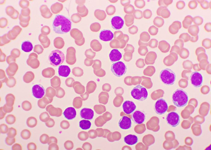 La nueva terapia para la leucemia linfoblástica de células T se basa en células CAR-T diseñadas para atacar células T tumorales y dejar intactas las células T normales