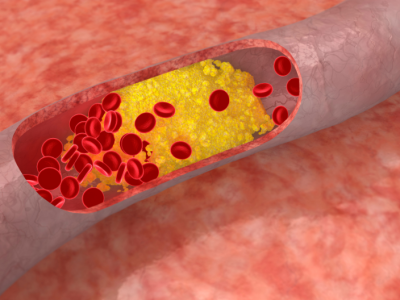 Ilustración de una placa de colesterol en una arteria. Los niveles elevados de colesterol están relacionados. Imagen: Getty Images, vía Canva.