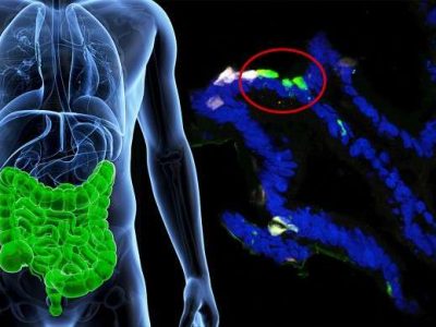 Células gastrointestinales de pacientes fueron modificadas para expresar insulina (mostrada en verde fluorescente). Imagen:  Columbia University Medical Center.
