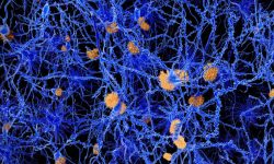 Ilustración de placas de proteína amiloide en el tejido nervioso, una de las características patológicas de la enfermedad de Alzheimer. Imagen: Science Photo Library, vía Canva.