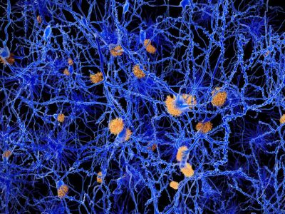 Ilustración de placas de proteína amiloide en el tejido nervioso, una de las características patológicas de la enfermedad de Alzheimer. Imagen: Science Photo Library, vía Canva.